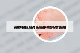 癬銀屑病魚鱗病 魚鱗病和銀屑病的區(qū)別