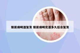 銀屑病喝酒復(fù)發(fā) 銀屑病喝完酒多久后會(huì)復(fù)發(fā)
