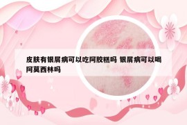 皮膚有銀屑病可以吃阿膠糕嗎 銀屑病可以喝阿莫西林嗎
