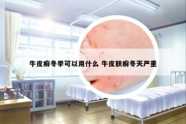 牛皮癬冬季可以用什么 牛皮膚癬冬天嚴(yán)重