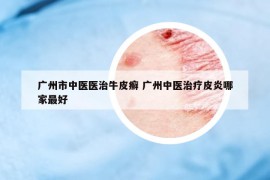 廣州市中醫(yī)醫(yī)治牛皮癬 廣州中醫(yī)治療皮炎哪家最好