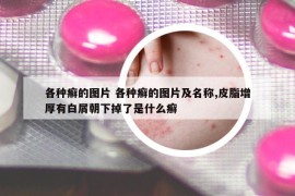 各種癬的圖片 各種癬的圖片及名稱,皮脂增厚有白屑朝下掉了是什么癬