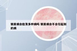 銀屑病會隱發(fā)多種病嗎 銀屑病會不會引起別的病