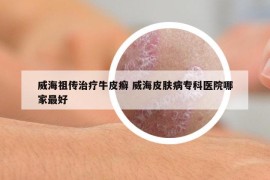 威海祖?zhèn)髦委熍Ｆぐ_ 威海皮膚病?？漆t(yī)院哪家最好