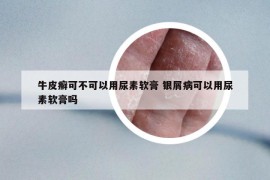 牛皮癬可不可以用尿素軟膏 銀屑病可以用尿素軟膏嗎
