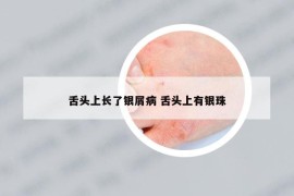舌頭上長了銀屑病 舌頭上有銀珠
