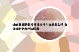 ch自體細胞免疫療法治療牛皮癬怎么樣 自體細胞免疫療法適用