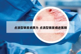 點(diǎn)滴型銀屑病賈力 點(diǎn)滴型銀屑病進(jìn)展期