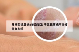 尋常型銀屑病8年沒復(fù)發(fā) 尋常銀屑病不治療能自愈嗎