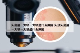 頭皮屑一大塊一大塊是什么原因 頭頂頭皮屑一大塊一大塊是什么原因