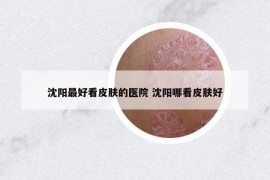 沈陽最好看皮膚的醫(yī)院 沈陽哪看皮膚好