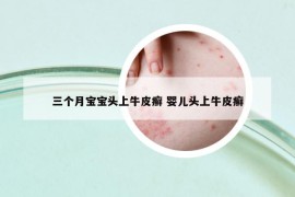 三個(gè)月寶寶頭上牛皮癬 嬰兒頭上牛皮癬