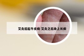 艾灸后起牛皮癬 艾灸之后身上長癬
