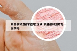 銀屑病和濕疹的部位區(qū)別 銀屑病和濕疹是一回事嗎