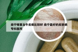 南寧哪里治牛皮癬比較好 南寧最好的皮膚病?？漆t(yī)院