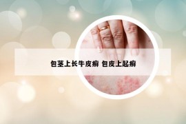包莖上長牛皮癬 包皮上起癬