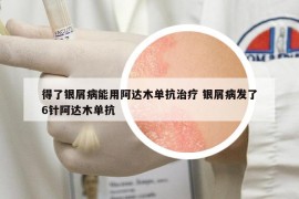 得了銀屑病能用阿達(dá)木單抗治療 銀屑病發(fā)了6針阿達(dá)木單抗
