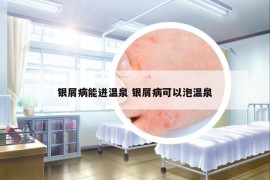 銀屑病能進(jìn)溫泉 銀屑病可以泡溫泉