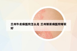 蘭州牛皮癬醫(yī)院怎么走 蘭州銀屑病醫(yī)院哪家好