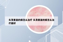 頭發(fā)里面的癬怎么治療 頭發(fā)里面的癬怎么治療最好