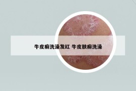 牛皮癬洗澡發(fā)紅 牛皮膚癬洗澡
