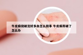 牛皮癬撓破流好多血怎么回事 牛皮癬弄破了怎么辦