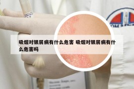 吸煙對(duì)銀屑病有什么危害 吸煙對(duì)銀屑病有什么危害嗎