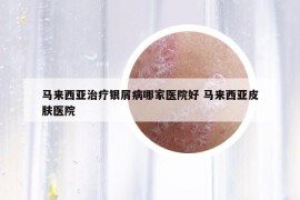 馬來西亞治療銀屑病哪家醫(yī)院好 馬來西亞皮膚醫(yī)院