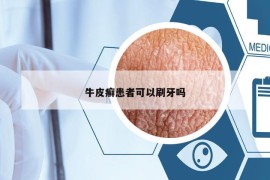 牛皮癬患者可以刷牙嗎