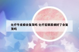 化療牛皮癬會復(fù)發(fā)嗎 化療后銀屑病好了會復(fù)發(fā)嗎