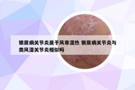 銀屑病關(guān)節(jié)炎屬于風(fēng)寒濕熱 銀屑病關(guān)節(jié)炎與類(lèi)風(fēng)濕關(guān)節(jié)炎相似嗎