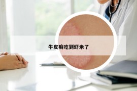 牛皮癬吃到蝦米了