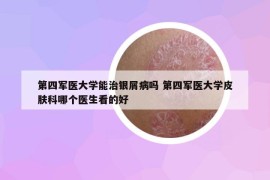 第四軍醫(yī)大學(xué)能治銀屑病嗎 第四軍醫(yī)大學(xué)皮膚科哪個(gè)醫(yī)生看的好