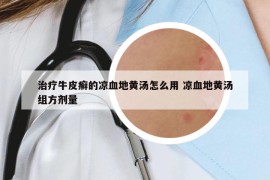 治療牛皮癬的涼血地黃湯怎么用 涼血地黃湯組方劑量