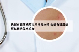 頭部有銀屑病可以用洗發(fā)水嗎 頭部有銀屑病可以用洗發(fā)水嗎女