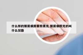 什么樣的銀屑病需要照黑光 銀屑病照光的叫什么儀器