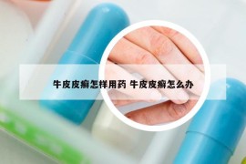 牛皮皮癬怎樣用藥 牛皮皮癬怎么辦