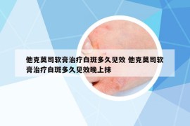 他克莫司軟膏治療白斑多久見(jiàn)效 他克莫司軟膏治療白斑多久見(jiàn)效晚上抹