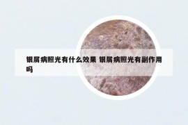 銀屑病照光有什么效果 銀屑病照光有副作用嗎