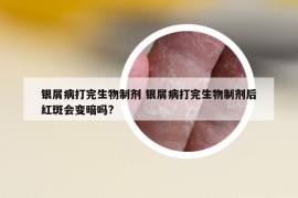 銀屑病打完生物制劑 銀屑病打完生物制劑后紅斑會(huì)變暗嗎?