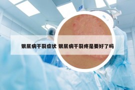 銀屑病干裂癥狀 銀屑病干裂疼是要好了嗎