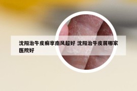 沈陽(yáng)治牛皮癬享南風(fēng)超好 沈陽(yáng)治牛皮屑哪家醫(yī)院好