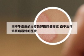 南寧牛皮癬的治療最好醫(yī)院是哪家 南寧治療銀屑病最好的醫(yī)院
