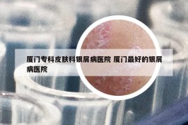 廈門?？破つw科銀屑病醫(yī)院 廈門最好的銀屑病醫(yī)院