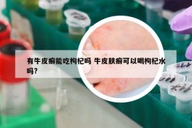 有牛皮癬能吃枸杞嗎 牛皮膚癬可以喝枸杞水嗎?