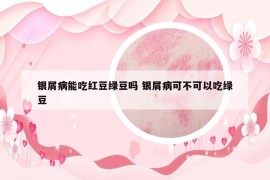 銀屑病能吃紅豆綠豆嗎 銀屑病可不可以吃綠豆