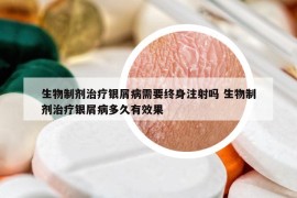 生物制劑治療銀屑病需要終身注射嗎 生物制劑治療銀屑病多久有效果