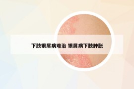 下肢銀屑病難治 銀屑病下肢腫脹