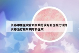 長(zhǎng)春哪里醫(yī)院看銀屑病比較好的醫(yī)院比較好 長(zhǎng)春治療銀屑病?？漆t(yī)院