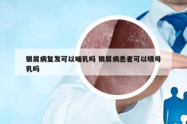 銀屑病復(fù)發(fā)可以哺乳嗎 銀屑病患者可以喂母乳嗎